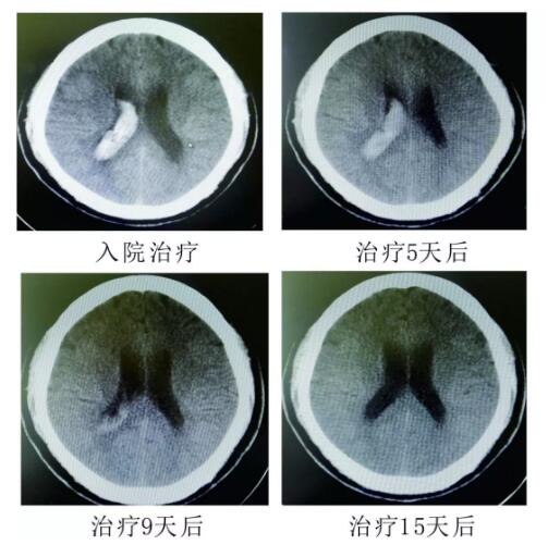 腦出血你不得不引起重視的疾?。。?！