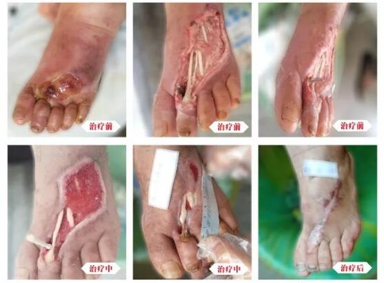 糖尿病并發(fā)癥有多可怕，及時(shí)治療糖尿病足避免截肢！