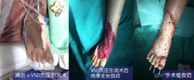 車(chē)禍猛如虎，救治如“華佗” ，手術(shù)＋康復(fù)，8歲小女孩車(chē)禍后日漸康復(fù)行走