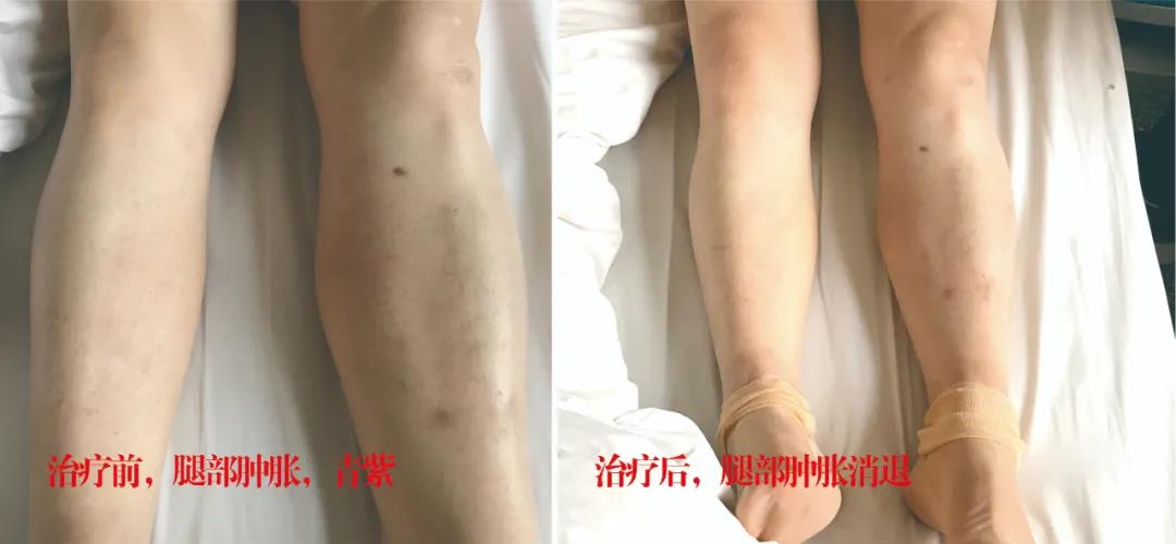 下肢靜脈血栓多年頑疾反復(fù)腫痛——疾病不容等待，早治療，早健康！