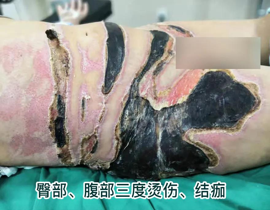 【保山安利醫(yī)院】80歲老人不慎燒傷，導(dǎo)致腹部、右側(cè)臀部大面積創(chuàng)傷，經(jīng)植皮治療創(chuàng)面逐漸愈合
