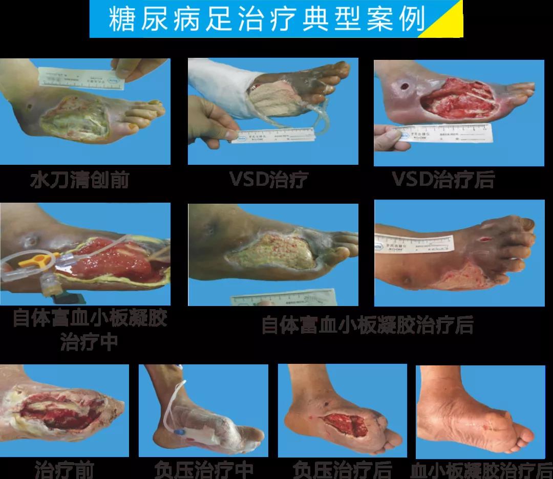截肢、失明，甚至……，我們要做的是將糖尿病并發(fā)癥遏制在搖籃里！