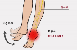 【保山安利醫(yī)院—健康科普】什么是足下垂！你了解嗎？